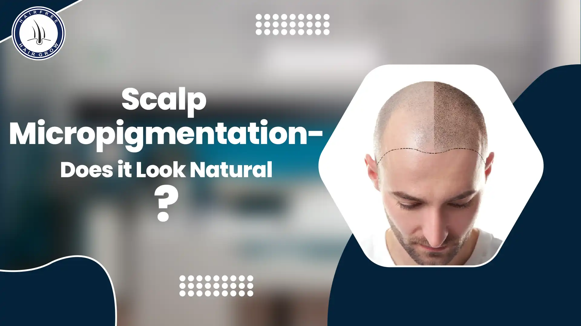 Does scalp micropigmentation look real? A comparison of natural results and expectations