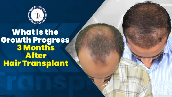 Before and after comparison showing hair growth progress 3 months after hair transplant