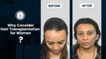 Before and after results of Hair Transplant for Women, showing improved hairline and thicker hair