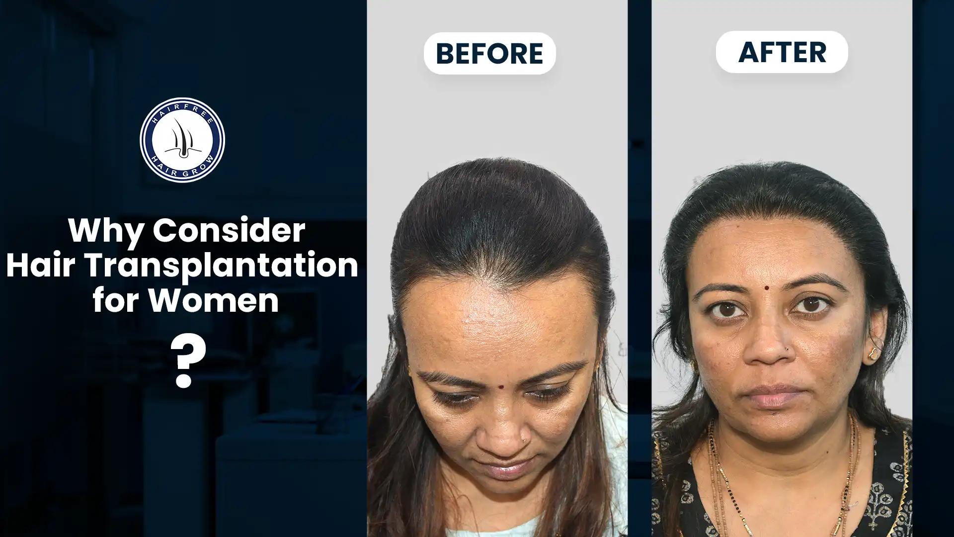 Before and after results of Hair Transplant for Women, showing improved hairline and thicker hair