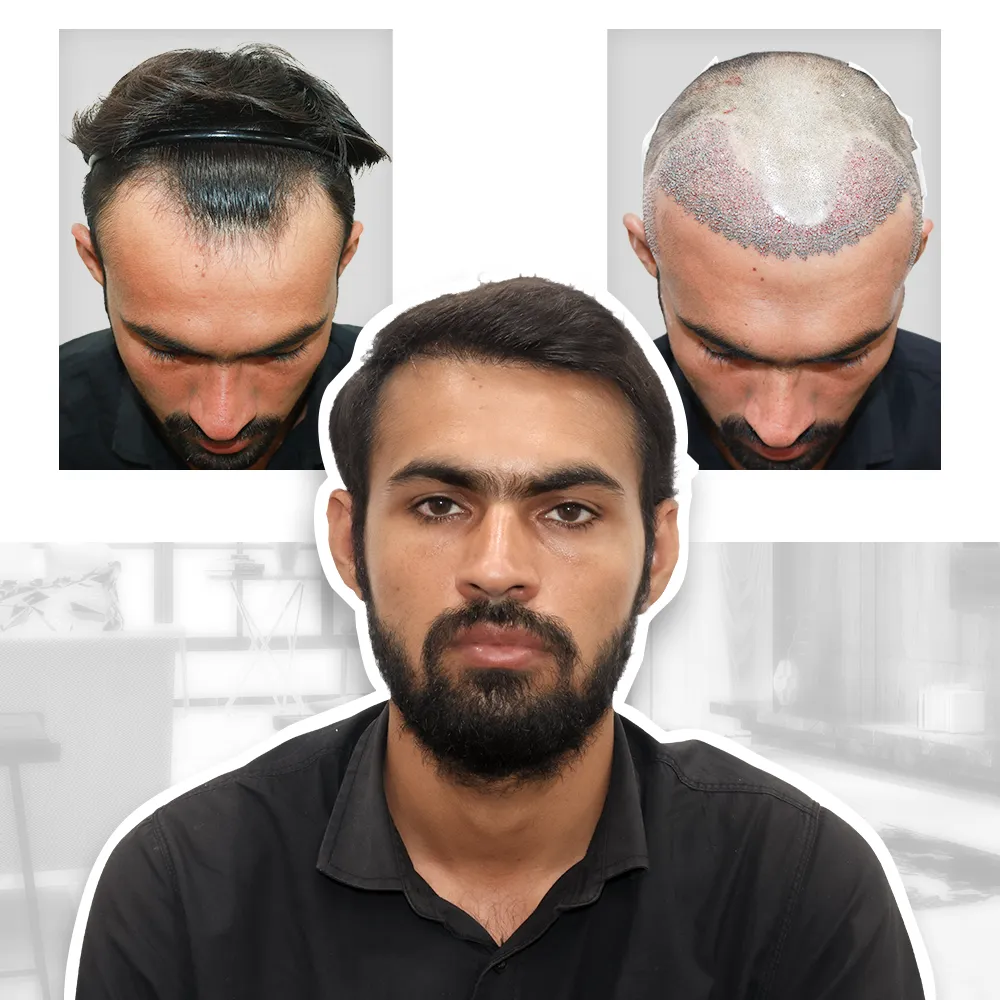 Bio Fue Hair Transplant Cost