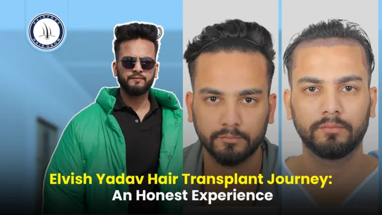 Elvish Yadav Hair Transplant: Before and After Journey