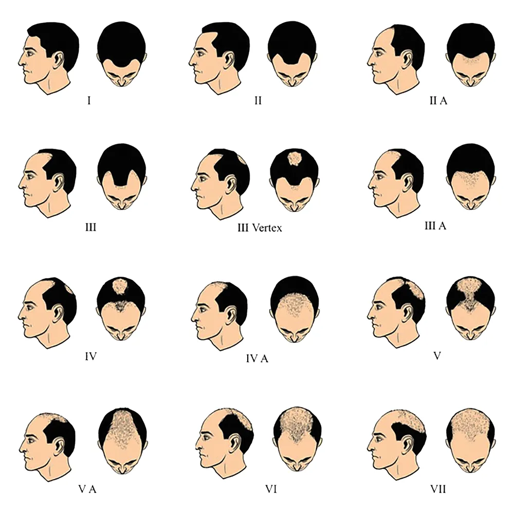 FUE Hair Transplant Cost cost per graft in India