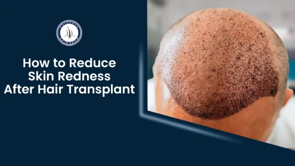 Redness After Hair Transplant: Causes and Solutions