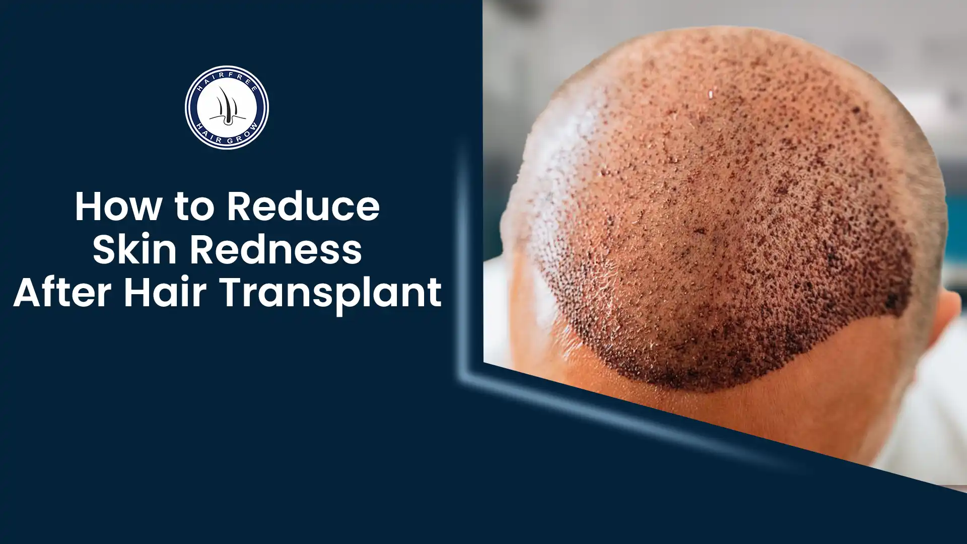 Redness After Hair Transplant: Causes and Solutions