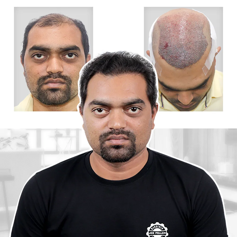 I FUE Hair Transplant Cost