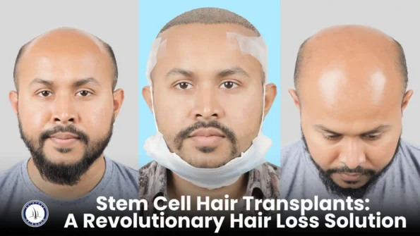 Stem Cell Hair Transplants before and after results showing hair regrowth in a man with baldness