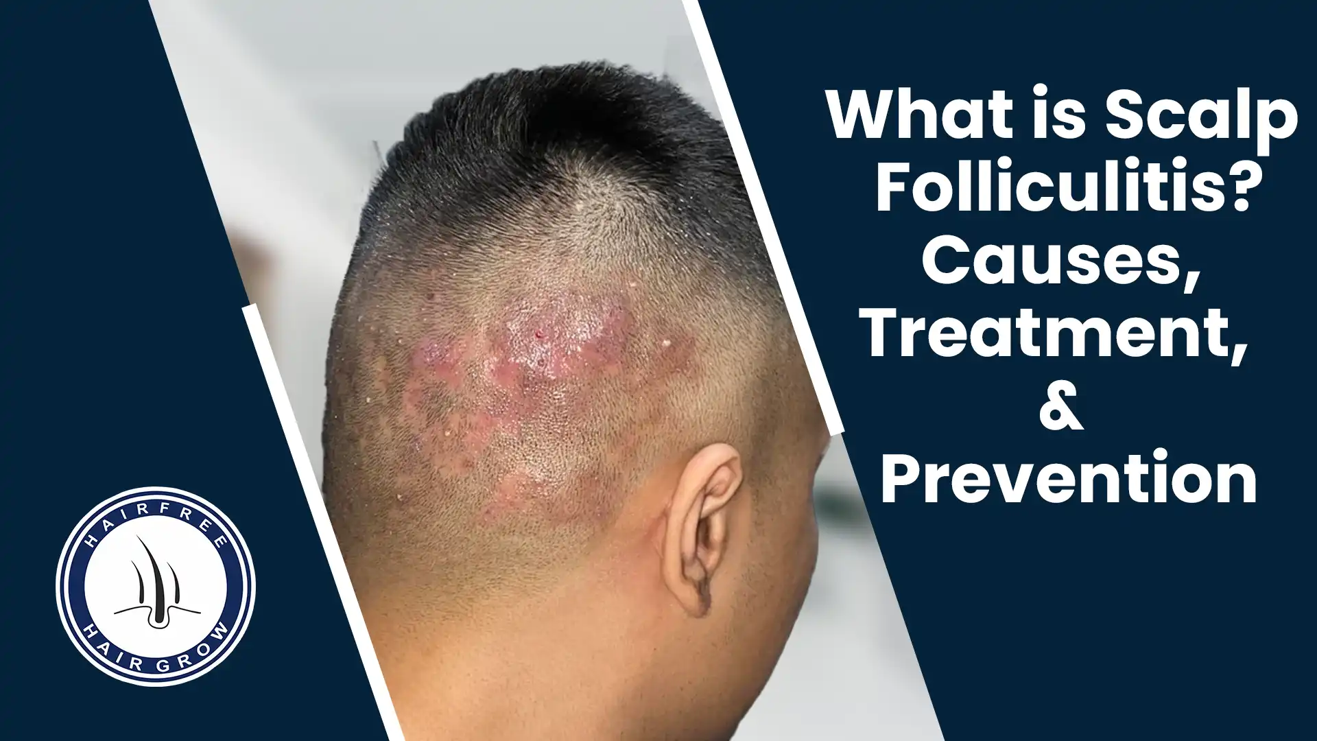 Scalp Folliculitis Causes Symptoms Treatment 2026