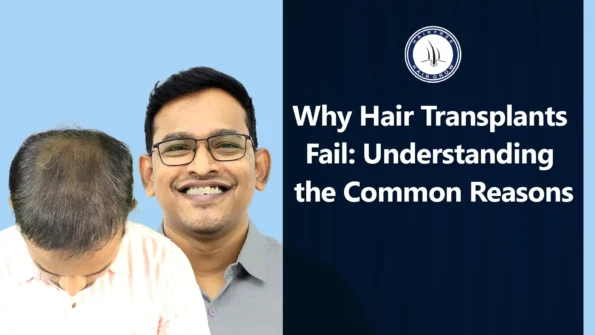 Why Hair Transplants Fail? Common reasons for unsuccessful hair restoration