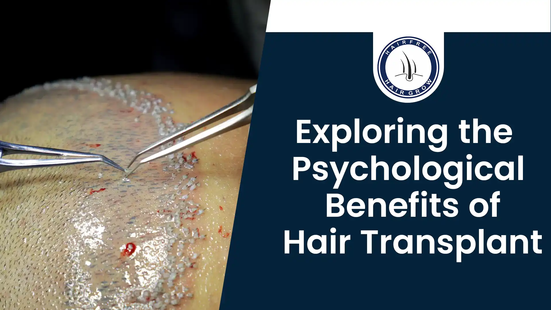 Benefits of Hair Transplant – Hair grafts being implanted
