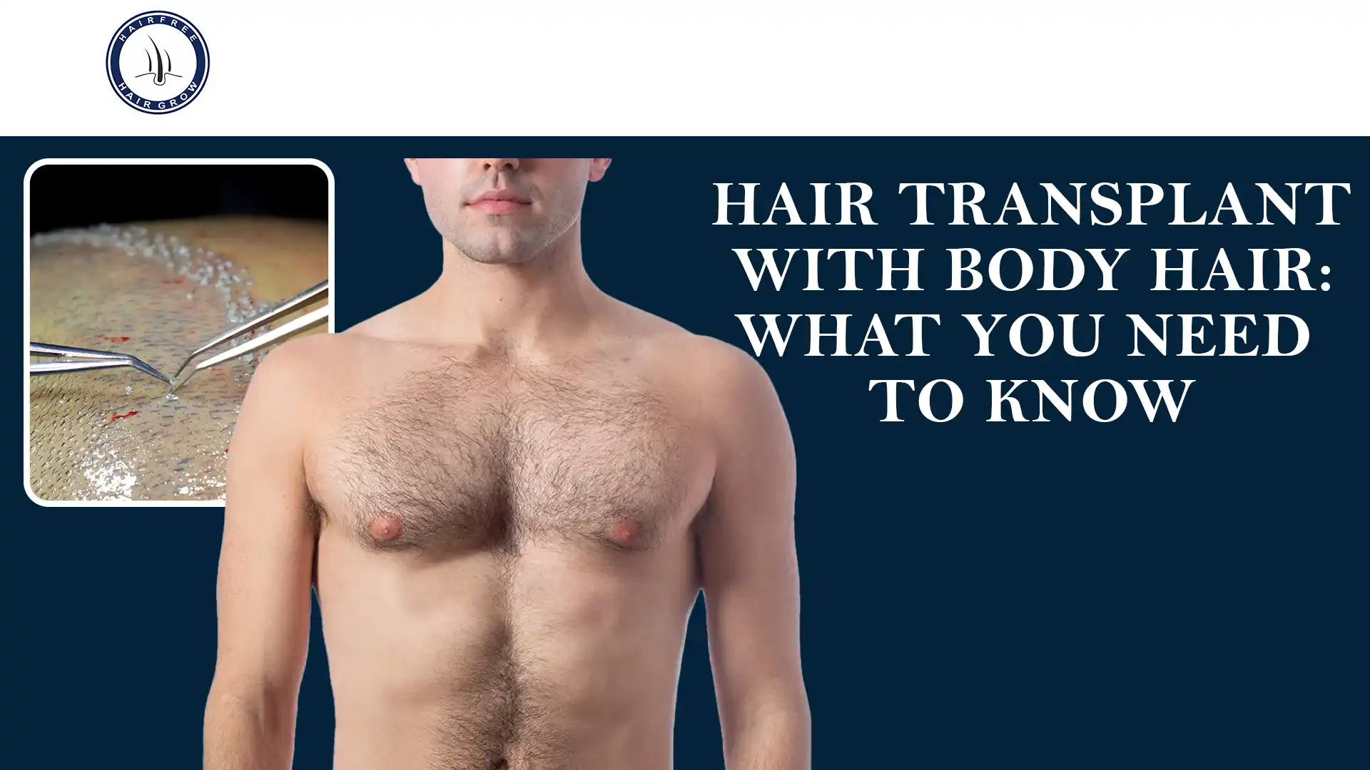 Hair Transplant With Body Hair – Using chest hair for hair restoration