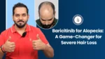 Baricitinib for Alopecia – Man showing hair regrowth success