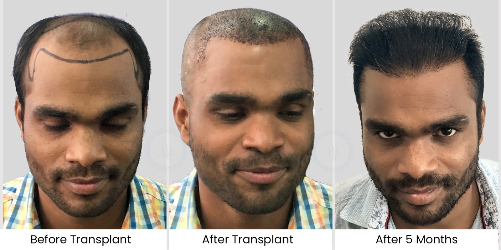 Mithun swain Coimbatore hair transplant Result front view