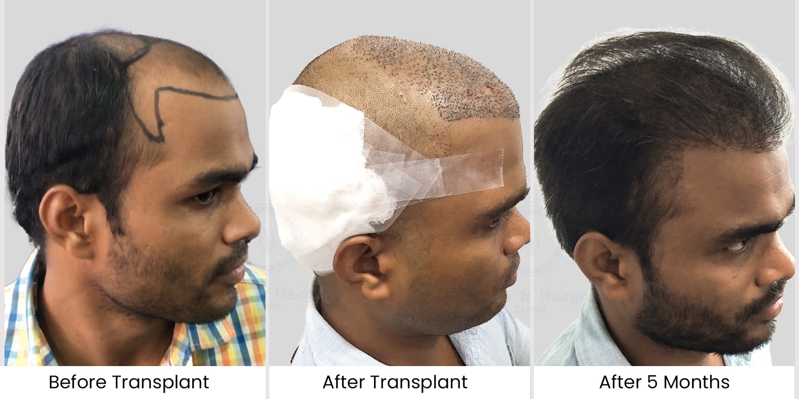 Mithun swain Coimbatore hair transplant Result left side view