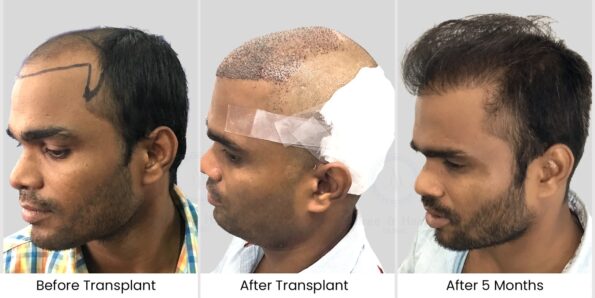 Mithun swain Coimbatore hair transplant Result right side view