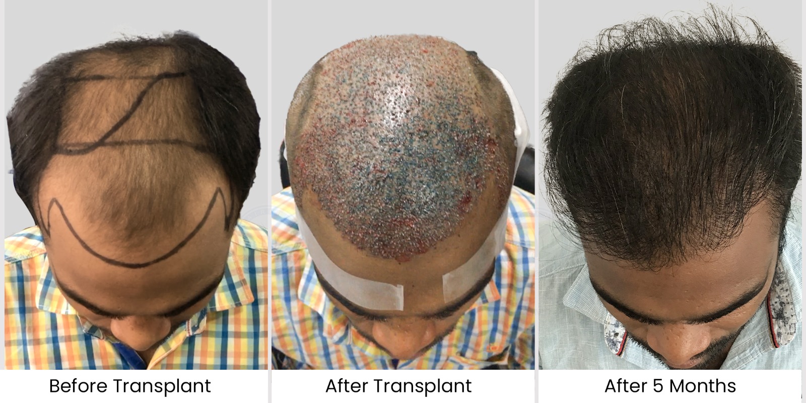 Mithun swain Coimbatore hair transplant Result top view