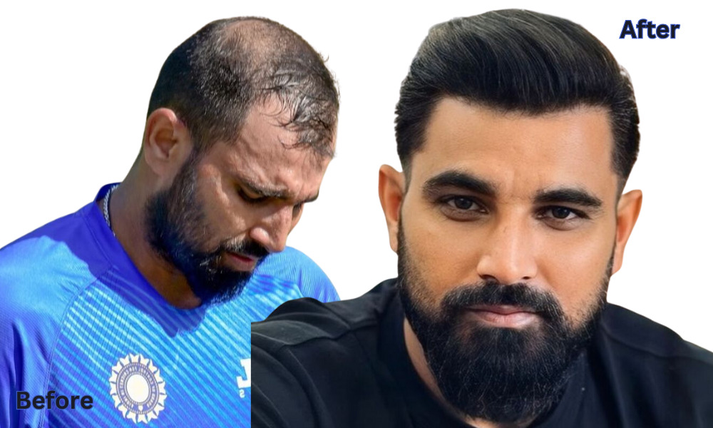 Before and After: Mohammed Shami Hair Transplant Transformation.