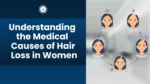 Medical Causes of Hair Loss in Women – Female hair thinning stages illustrated