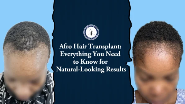 Afro hair transplant before and after image for natural results