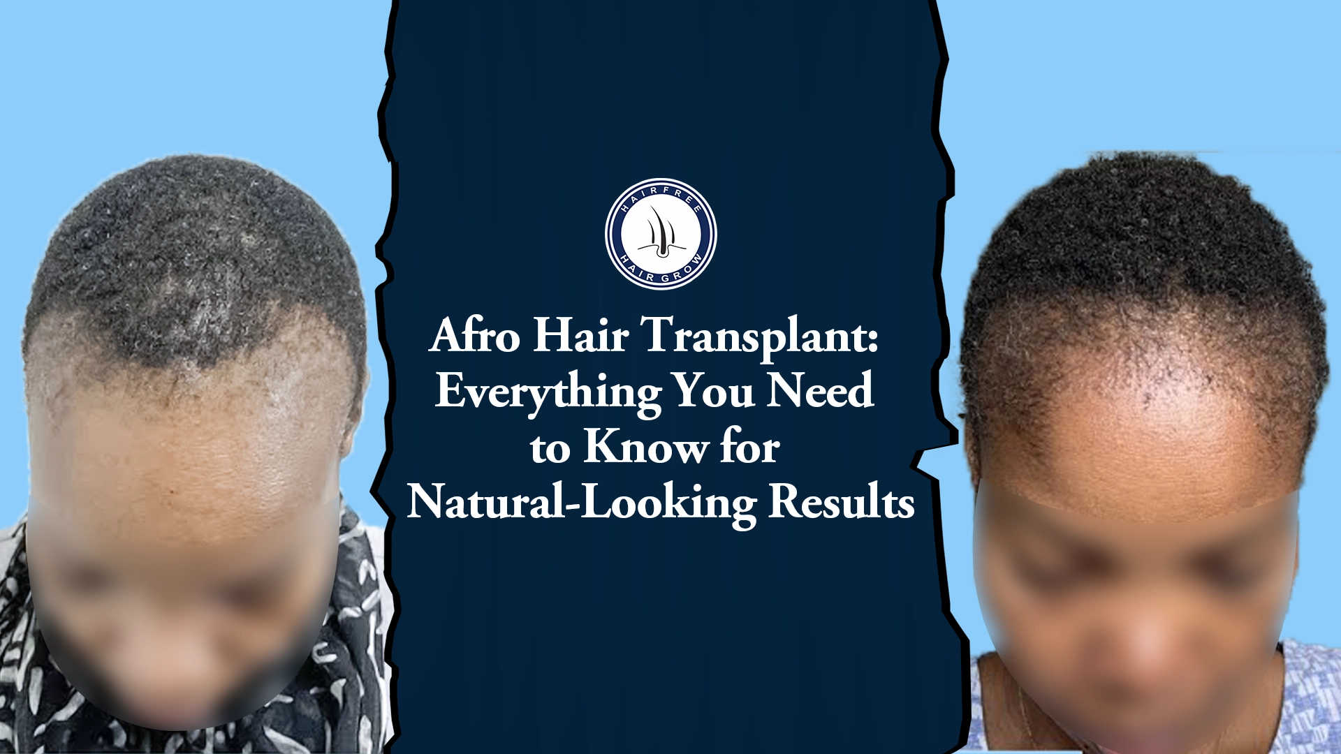 Afro hair transplant before and after image for natural results