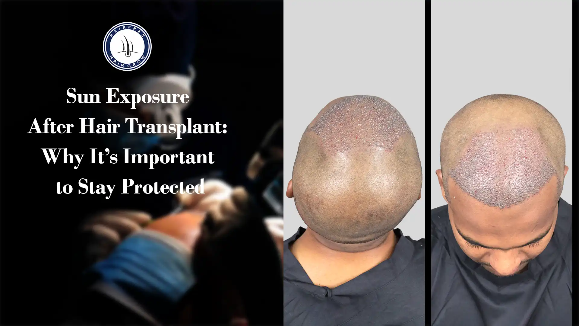 Sun Exposure After Hair Transplant and how to protect scalp