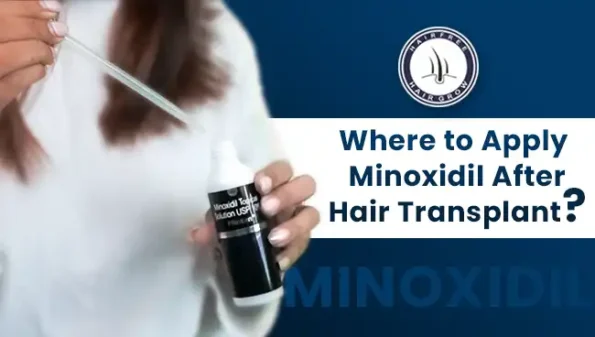 Woman holding minoxidil dropper – Where to Apply Minoxidil After Hair Transplant