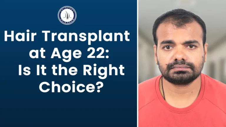Hair Transplant at Age 22 – early hair loss concern