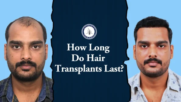 How Long Do Hair Transplants Last – before and after hair transplant result