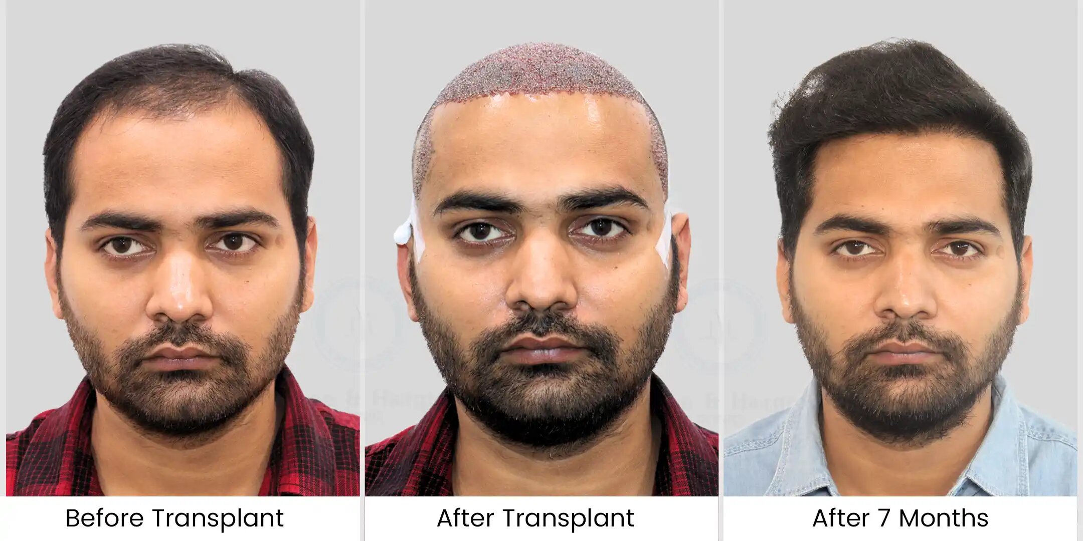 hair transplant patient case study