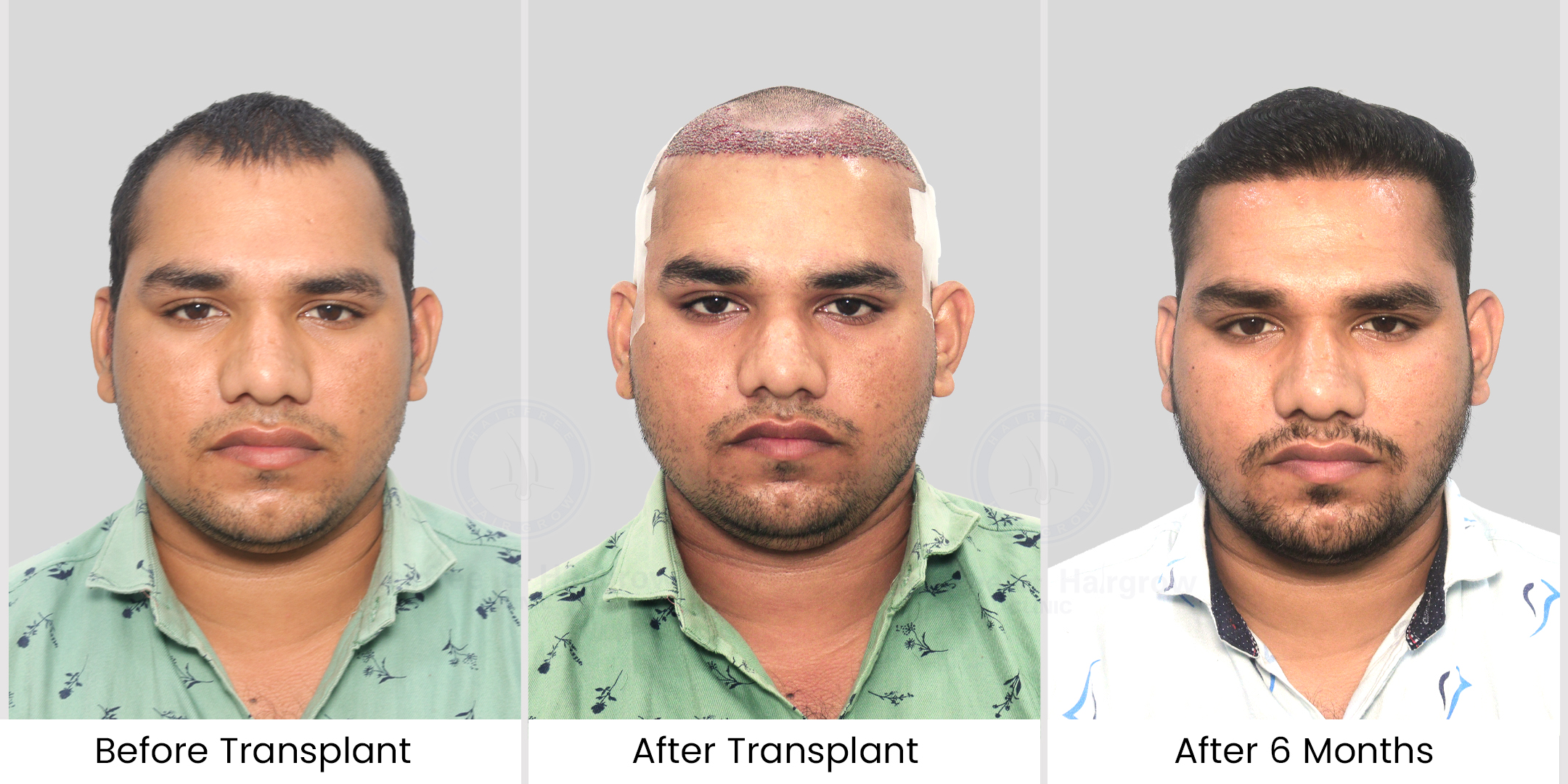 hair transplant before after photos