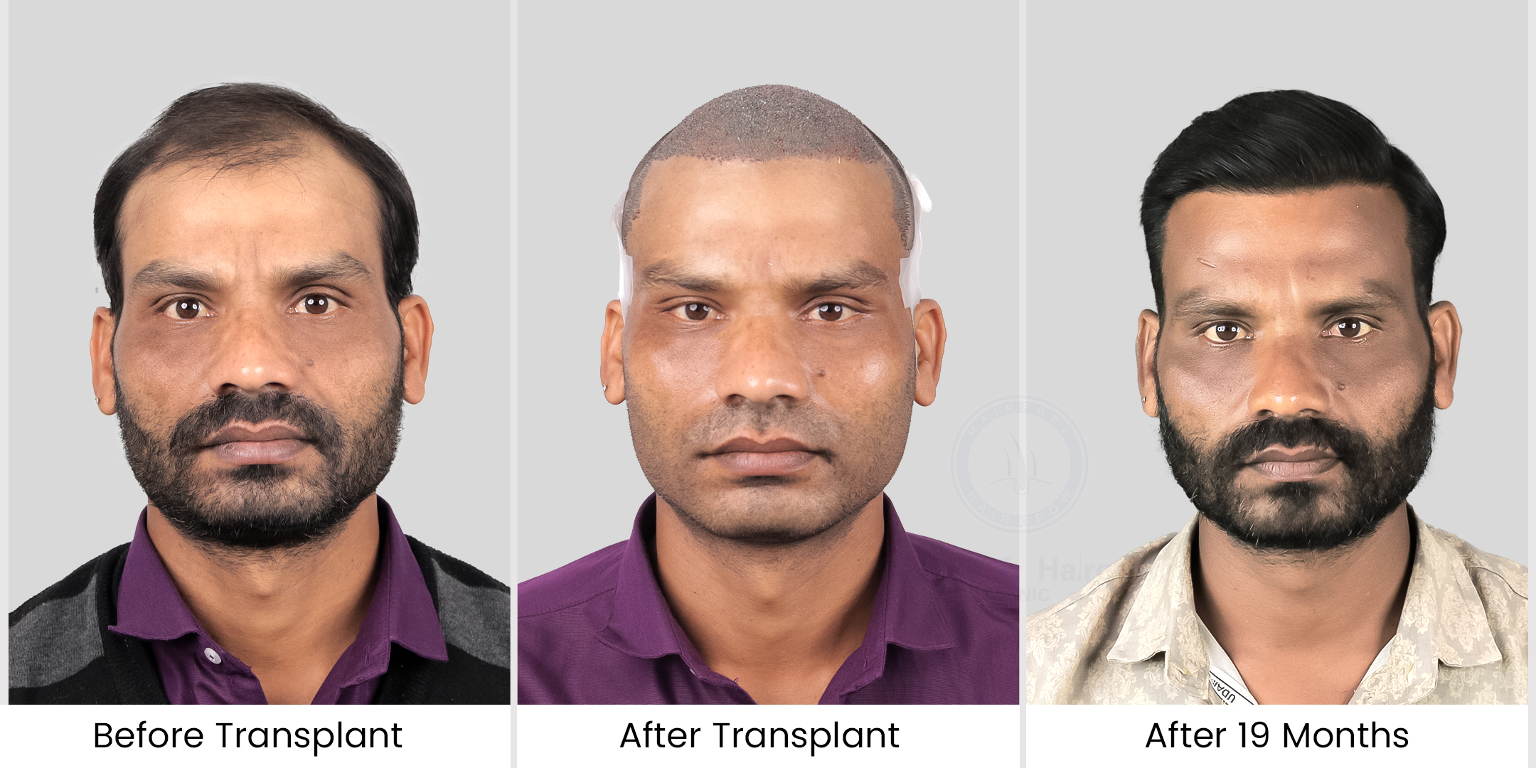 hair transplant before after photos