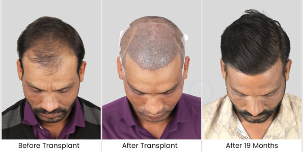 hair transplant before after photos