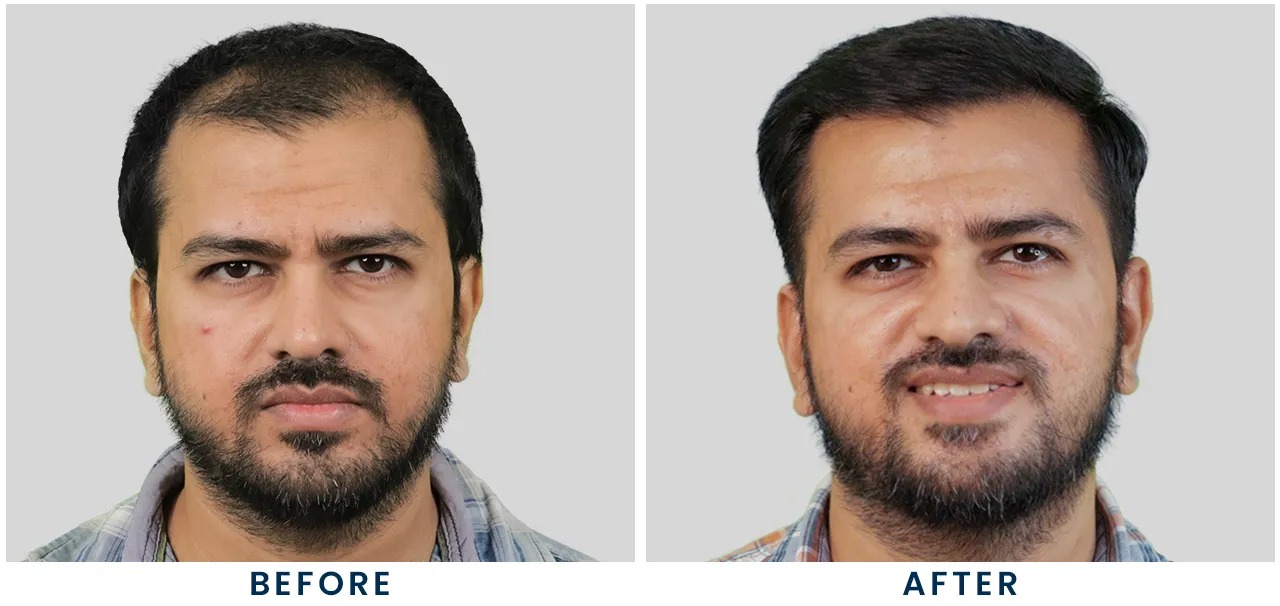 Hair Transplant Cost in Visakhapatnam: Is It Worth It? What to Expect 1 Hair transplant cost in Visakhapatnam with before and after result