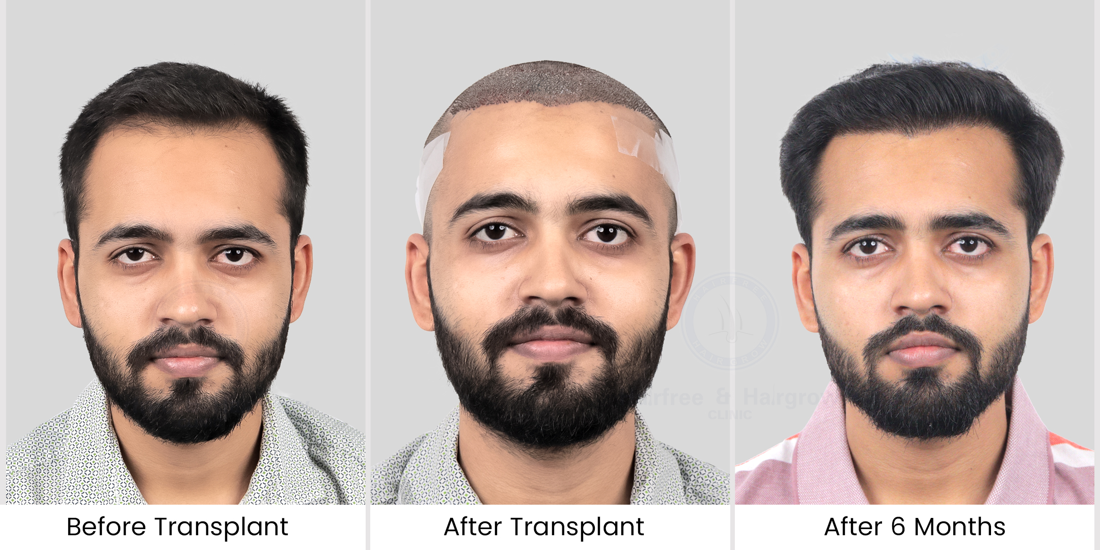 hair transplant before after photos