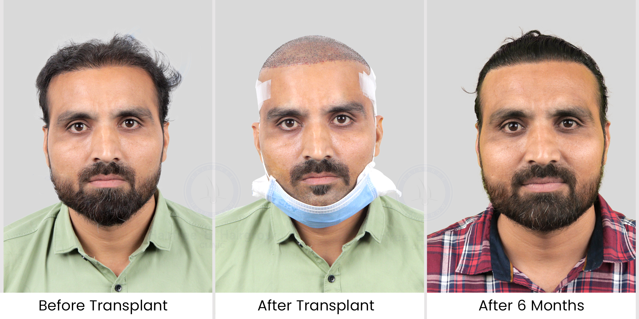 hair transplant before - after photos