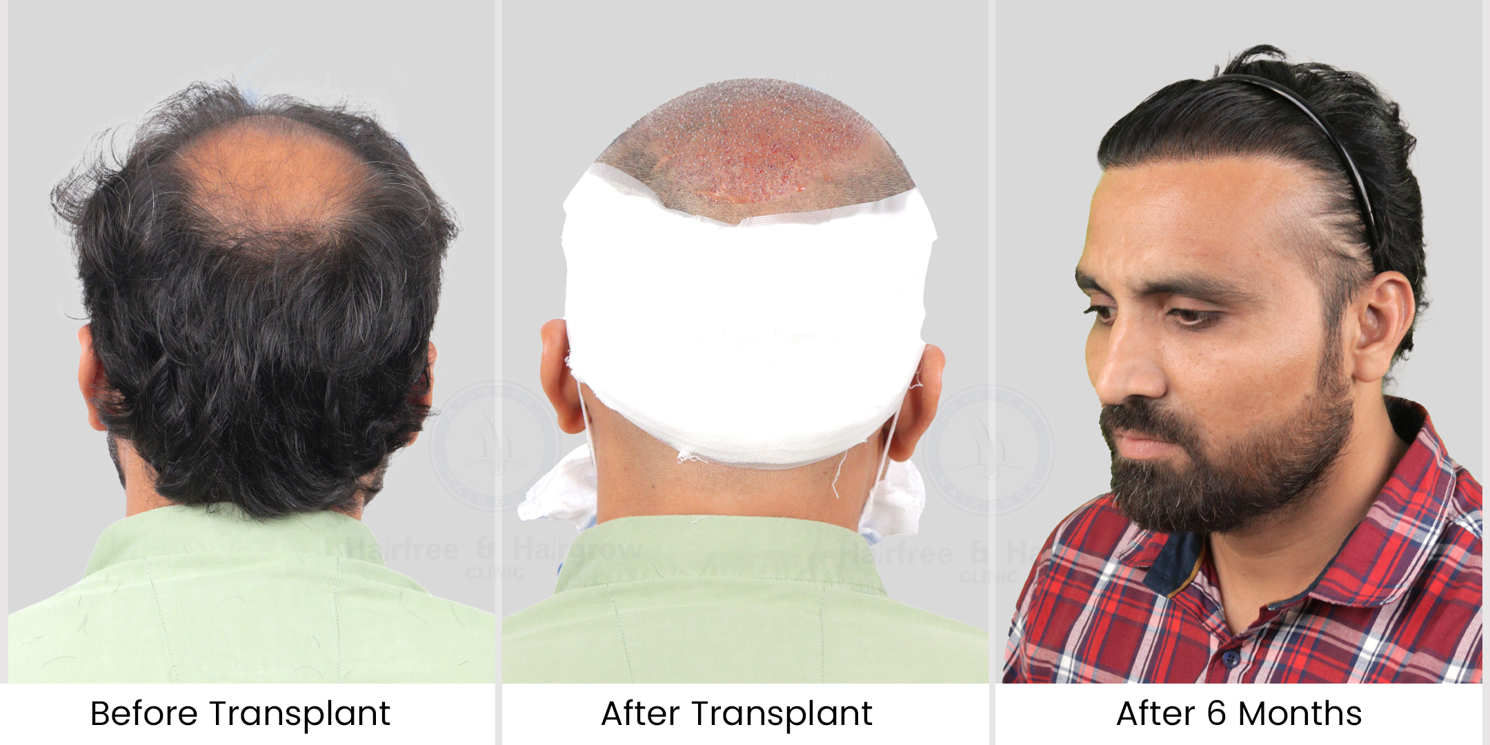 hair transplant before - after photos
