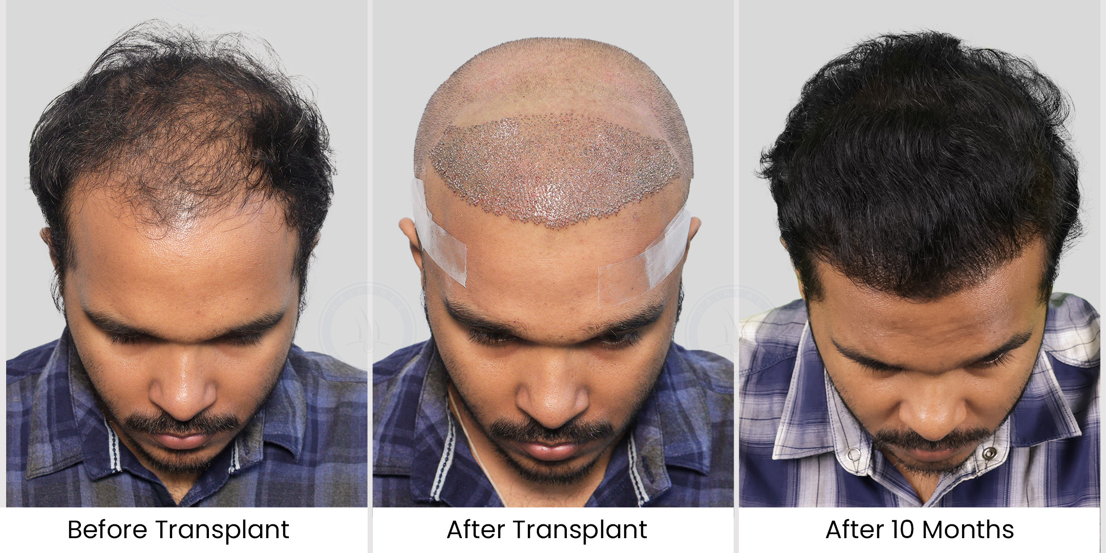 Hair Transplants Before After Photos