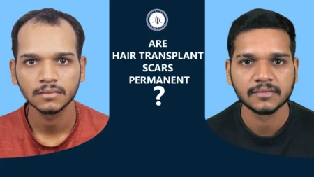 Are Hair Transplant Scars Permanent – before and after hair transplant