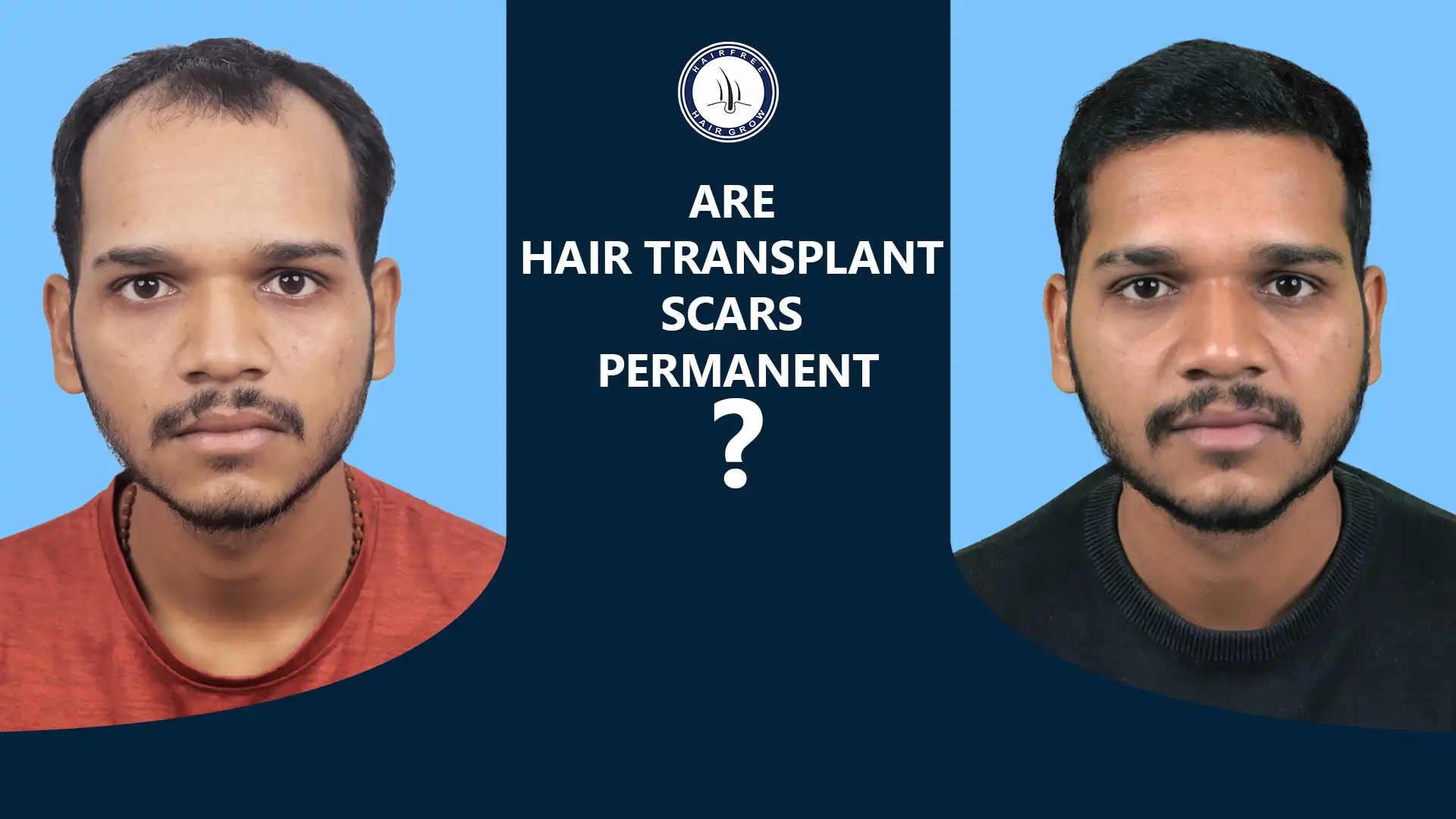 Are Hair Transplant Scars Permanent – before and after hair transplant
