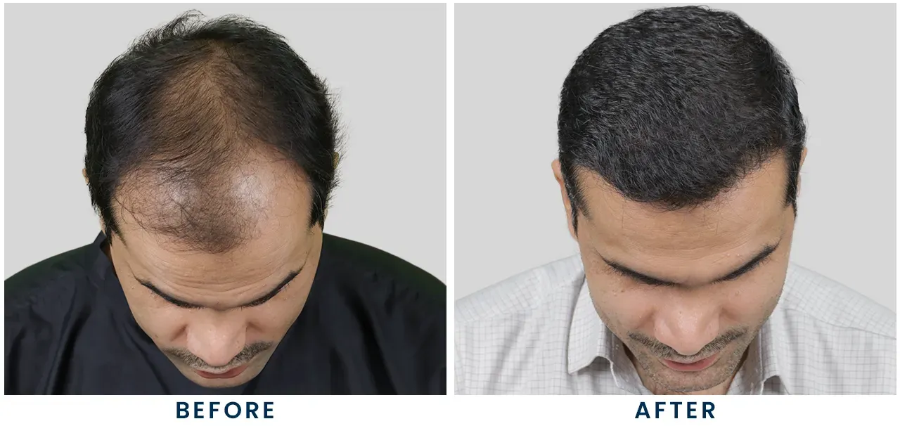 No 1 Hair Transplant Clinic in India Revealed: Hairfree Hairgrow 1 No 1 Hair Transplant Clinic in India with Before and after results
