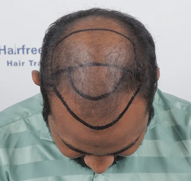 Hairline Marking Top