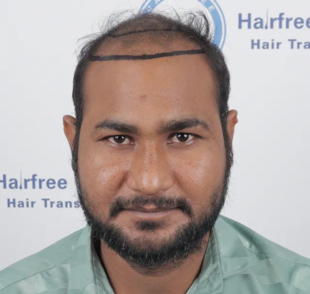 Hairline Marking