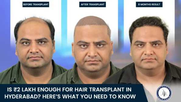 Is 2 Lakh Enough for Hair Transplant in Hyderabad with before and after results