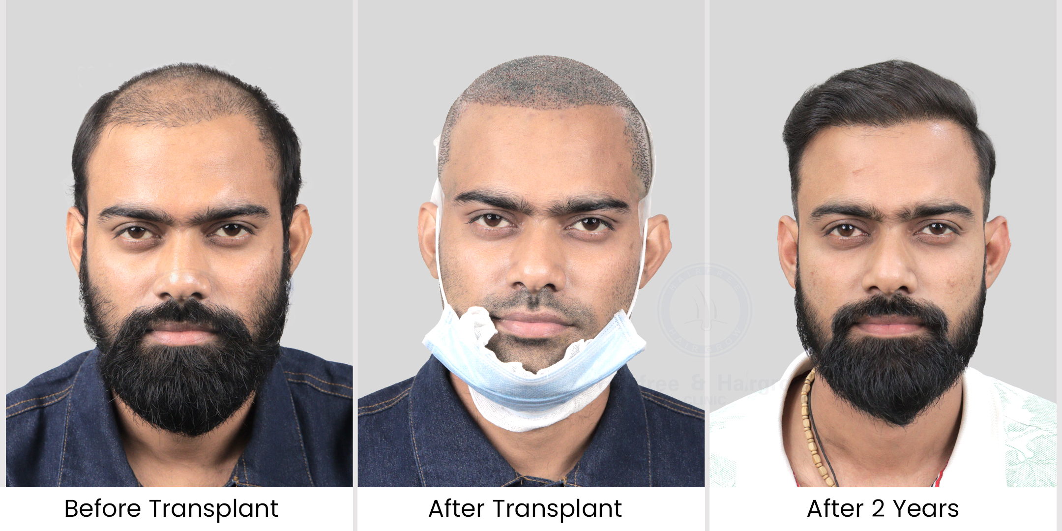 Here is patients after & before image