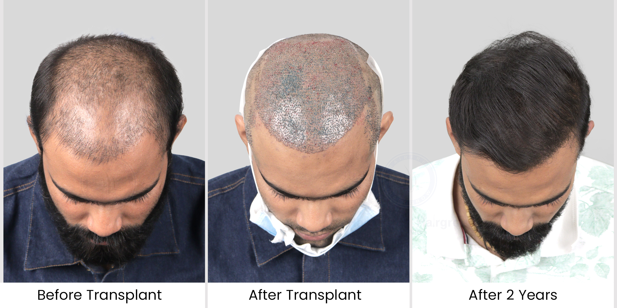 Here is patients after & before image
