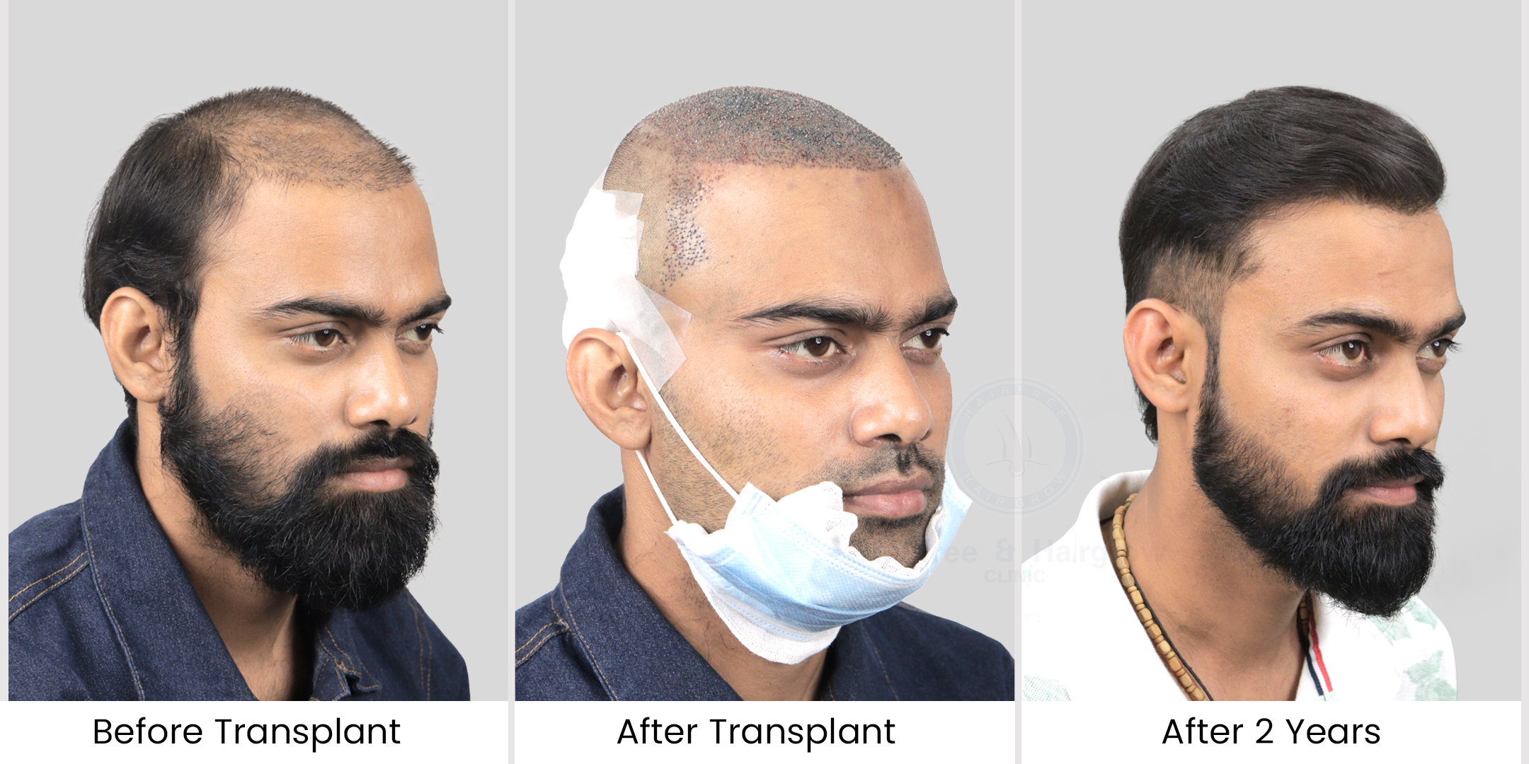 Here is patients after & before image