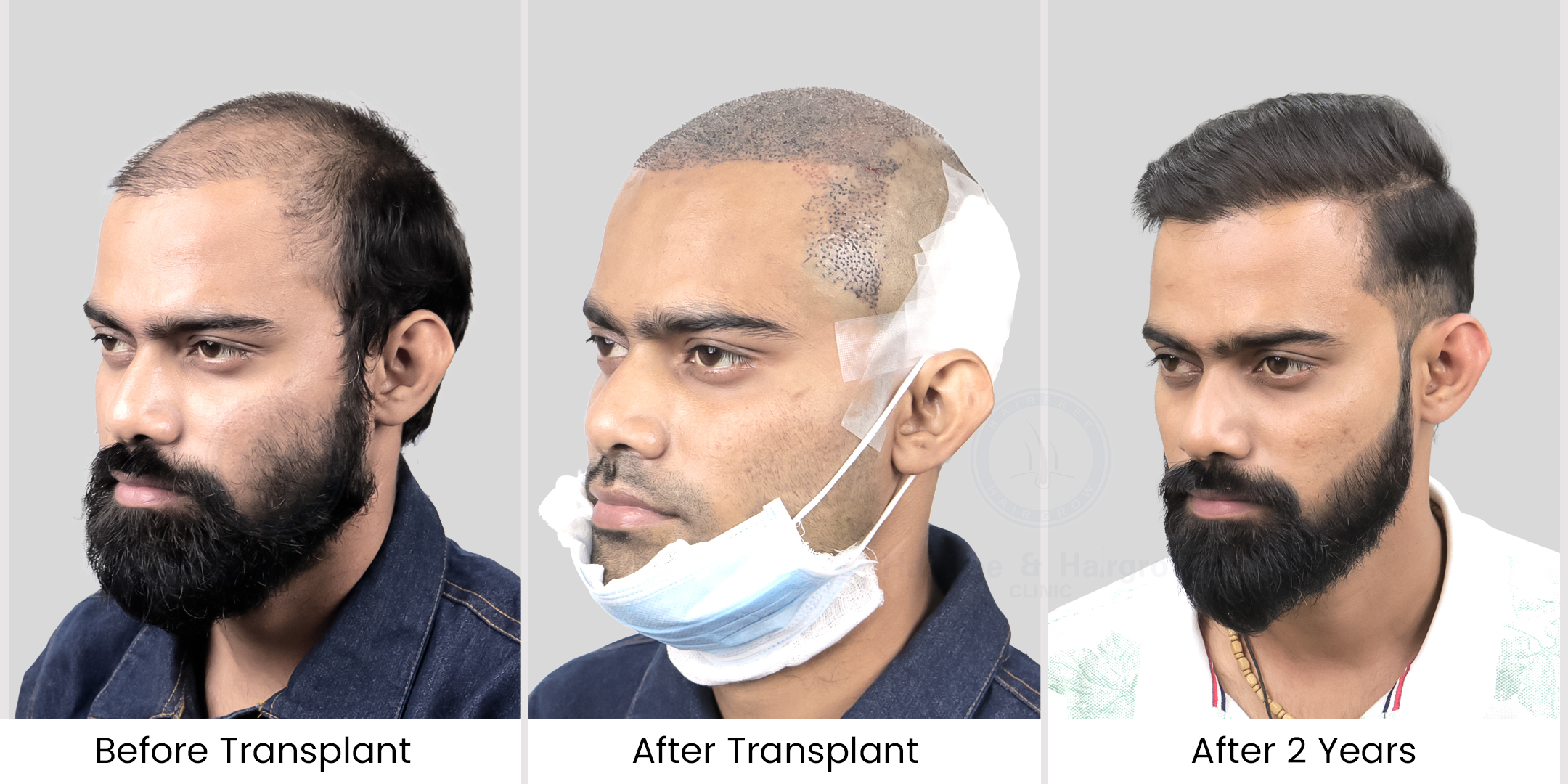 Here is patients after & before image