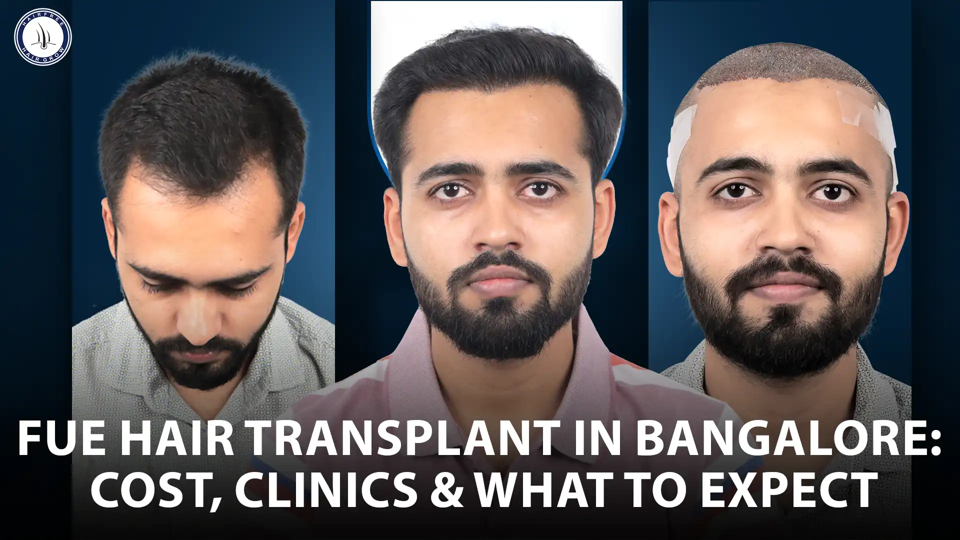 Best fue hair transplant with affordable cost clinic in bangalore