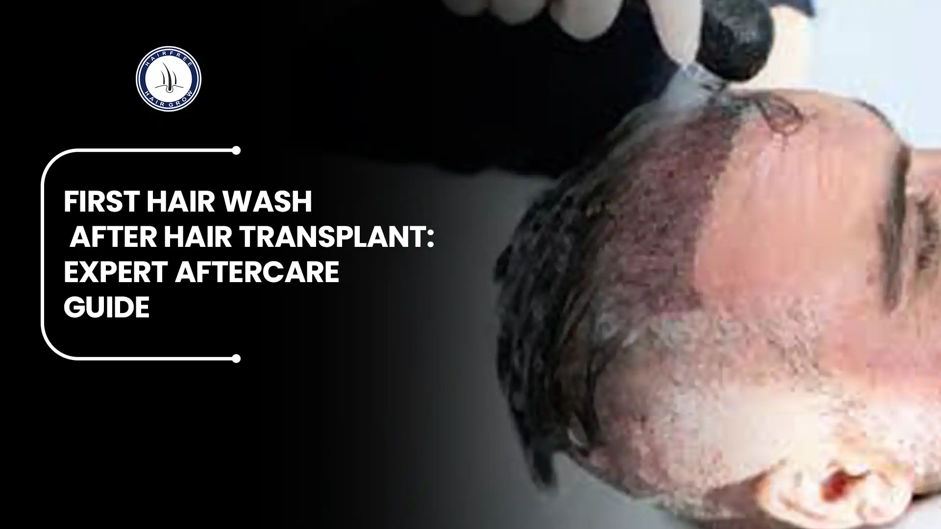 Blog 25 First Hair Wash After Hair Transplant Expert Aftercare Guide