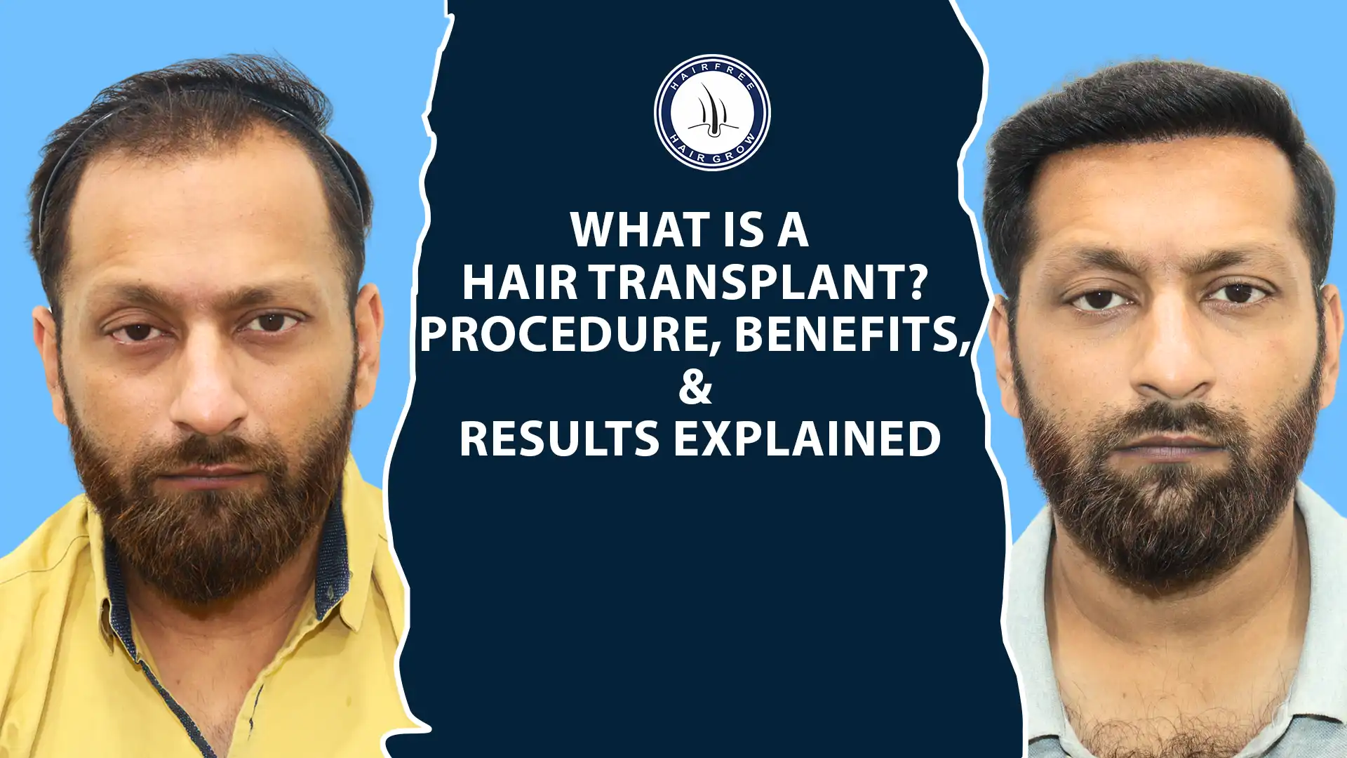 What is a Hair Transplant and how its work.